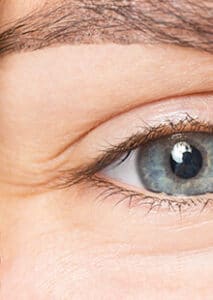 Szarkaláb, szem körüli ráncok eltűntetése, Botox kezelés, mimikai ráncok eltűntetése, mély statikus ráncok eltűntetése, Foxxi Medical Arcesztétika